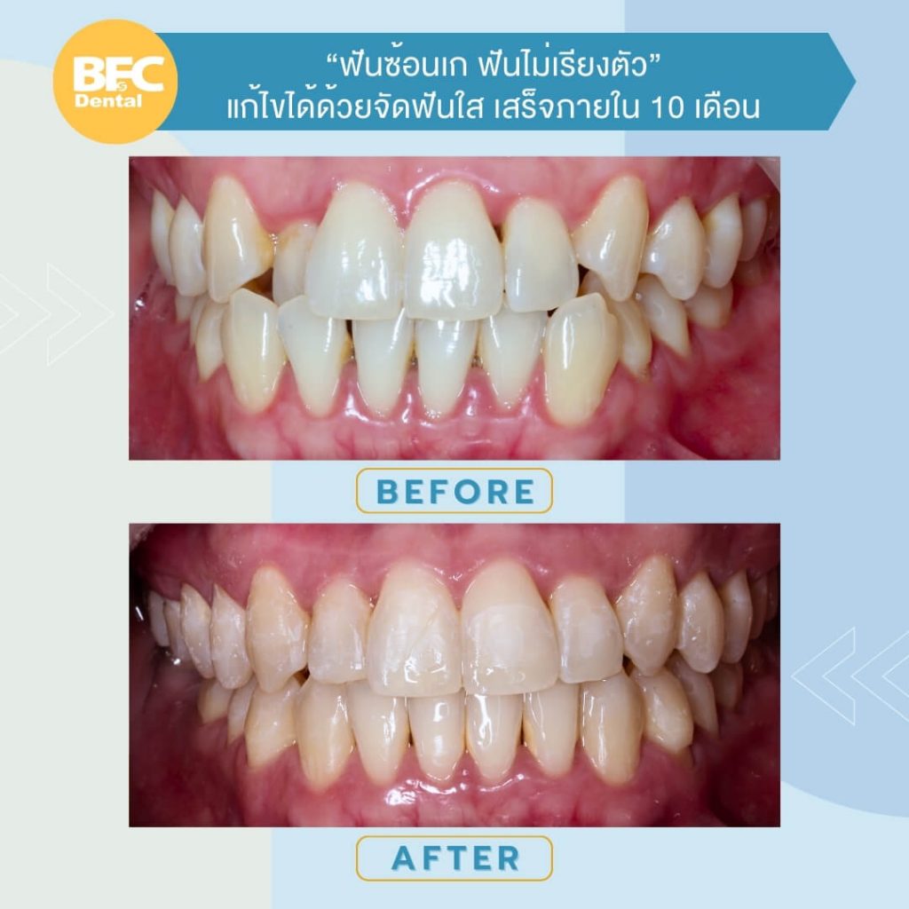 จัดฟันใส Käse Aligner 