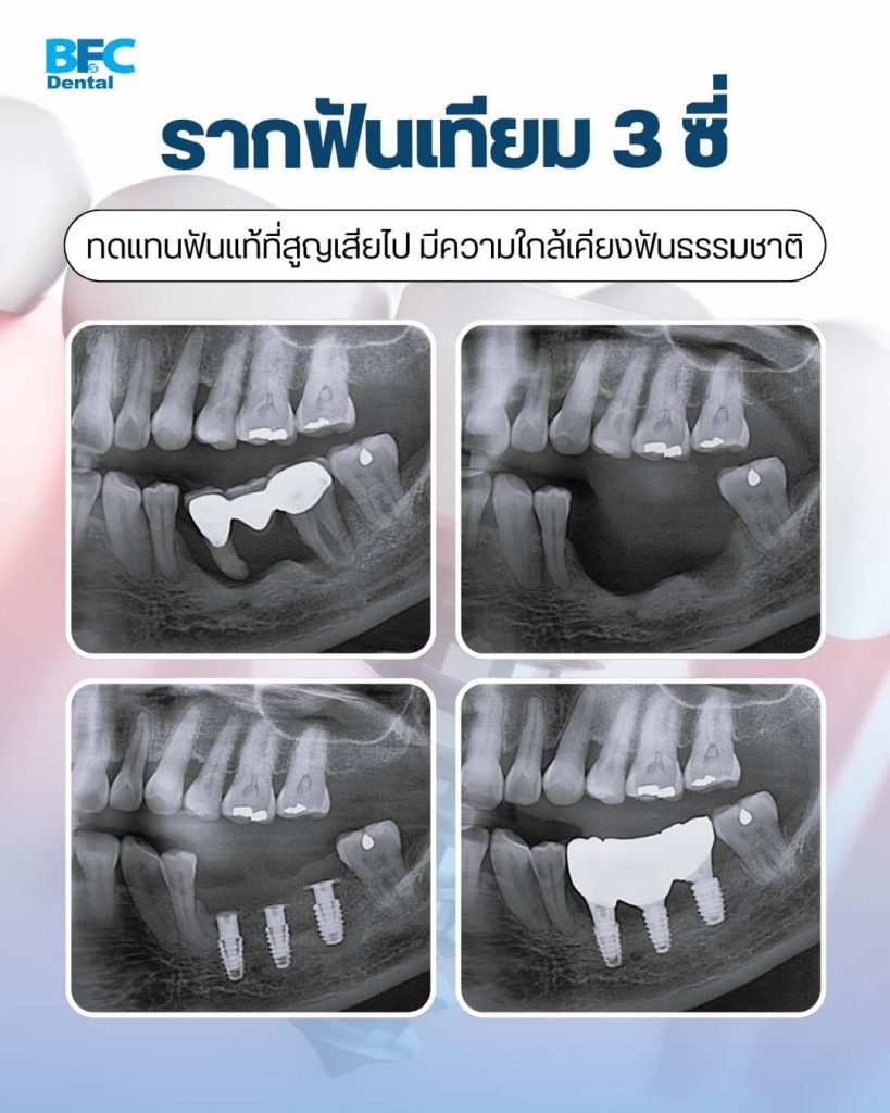 เทคนิค Tenting Pole