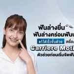 ฟันล่างยื่น ฟันล่างคร่อมฟันบน แก้ได้เร็วขึ้นด้วย เครื่องมือ Carriere Motion ตัวช่วยก่อนเริ่มจัดฟัน