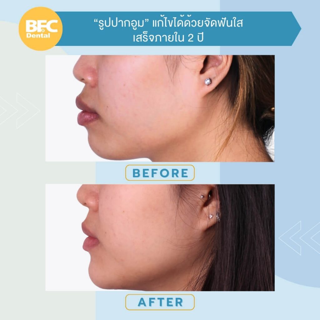 จัดฟันใสแก้ปากอูม 