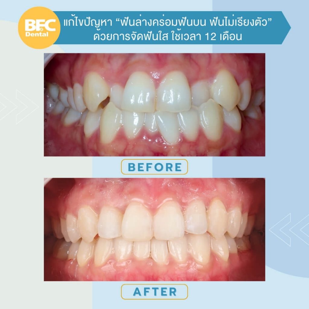 ฟันล่างคร่อมฟันบน